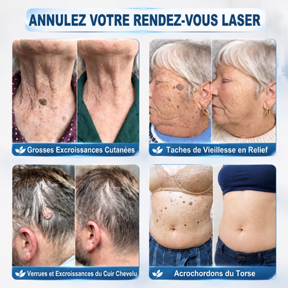 【🫧 Dernier jour : -70 % 🫧】🇫🇷 𝐇𝐞𝒂𝒍𝗿𝗶𝙯𝙚® Patch 2-en-1 à micro-aiguilles & hydrocolloïde | Aide à réduire l’apparence des grains de beauté, verrues, acné et étiquettes cutanées | Patchs invisibles visage & corps.
