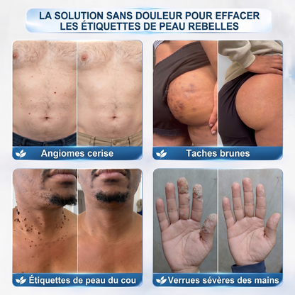 【🫧 Dernier jour : -70 % 🫧】🇫🇷 𝐇𝐞𝒂𝒍𝗿𝗶𝙯𝙚® Patch 2-en-1 à micro-aiguilles & hydrocolloïde | Aide à réduire l’apparence des grains de beauté, verrues, acné et étiquettes cutanées | Patchs invisibles visage & corps.