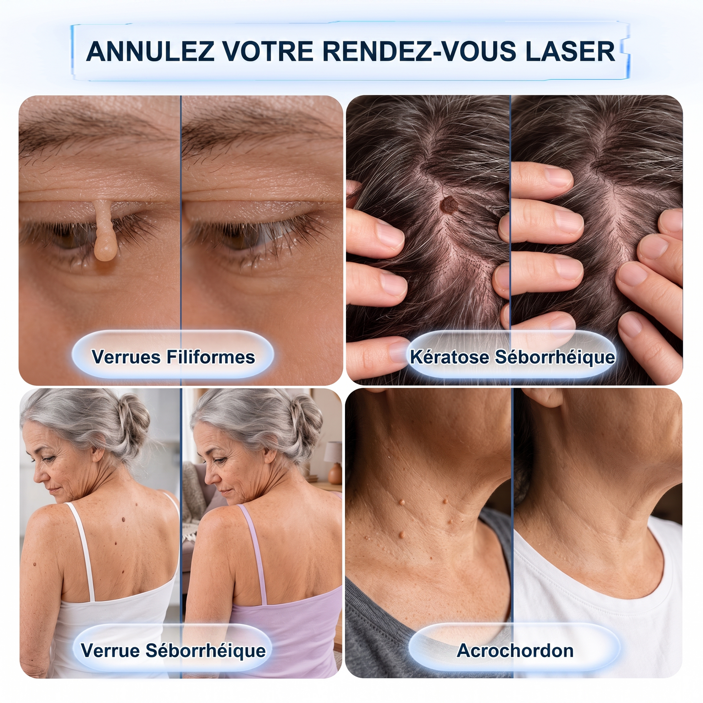【🫧 Dernier jour : -70 % 🫧】🇫🇷 𝐇𝐞𝒂𝒍𝗿𝗶𝙯𝙚® Patch 2-en-1 à micro-aiguilles & hydrocolloïde | Aide à réduire l’apparence des grains de beauté, verrues, acné et étiquettes cutanées | Patchs invisibles visage & corps.