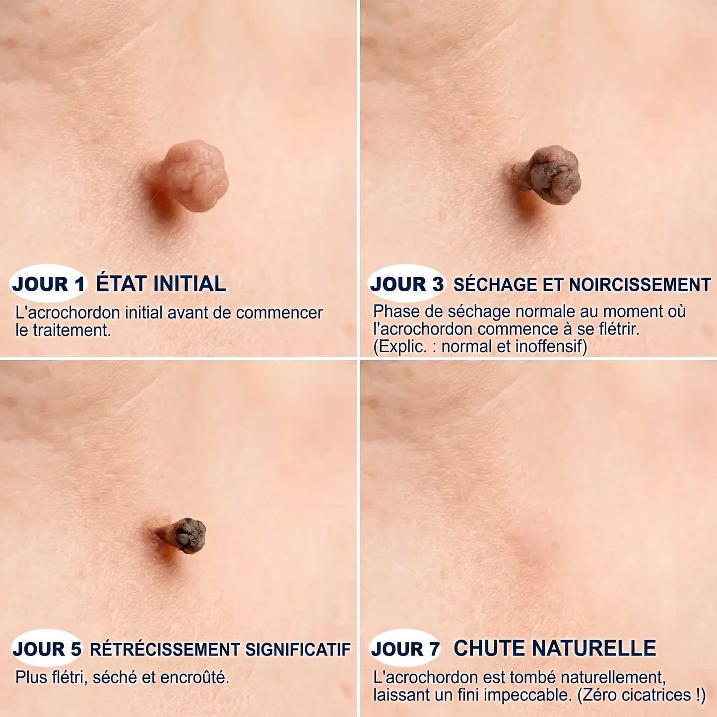 【🫧 Dernier jour : -70 % 🫧】🇫🇷 𝐇𝐞𝒂𝒍𝗿𝗶𝙯𝙚® Patch 2-en-1 à micro-aiguilles & hydrocolloïde | Aide à réduire l’apparence des grains de beauté, verrues, acné et étiquettes cutanées | Patchs invisibles visage & corps.